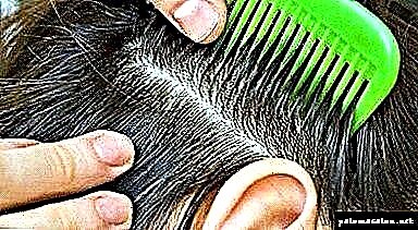 روش تعیین علت طاسی یا آزمایشاتی که باید انجام شود در صورت ریزش مو