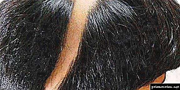 Nest alopecia: mgbaàmà, ihe na-akpata, nkebi