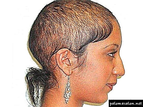 Calvicie (alopecia): cales son as causas, os tipos e as etapas dos homes e das mulleres