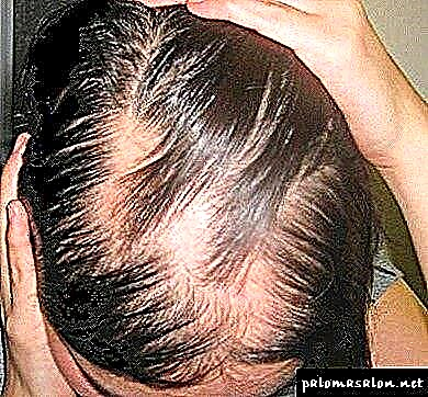 Alopecia - lefu lena ke eng? Lisosa, matšoao, kalafo ea alopecia
