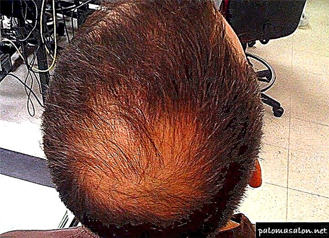 Alopecia - jinis, nyababkeun sareng perlakuan pikeun botak