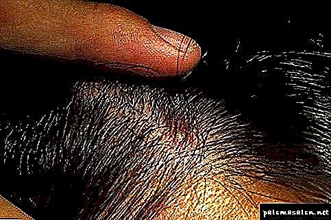 Зошто акните се појавуваат на главата во косата и како да се третираат