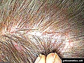 Վիրավորներ գլխի և մազերի մեջ. Պատճառներ և բուժում