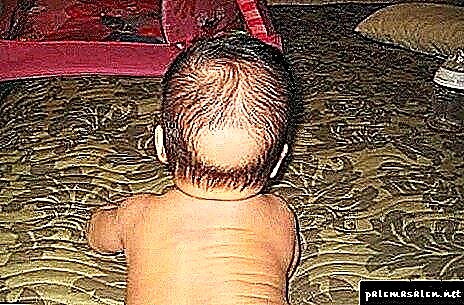 Perda de cabelo nos nenos: causas e que facer
