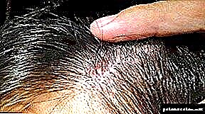 Folliculitis: panyebab peradangan bohlam rambut lan metode perawatan