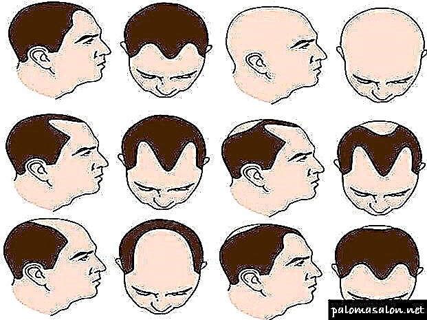 მამაკაცებში თმის ცვენის პროფილაქტიკის 5 გზა
