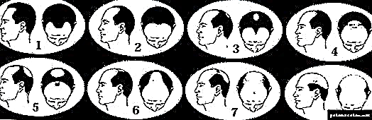 5 aħjar rimedji kontra l-baldness