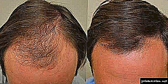 Trin alopecia gyda Minoxidil
