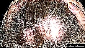 Seborrea alopecio